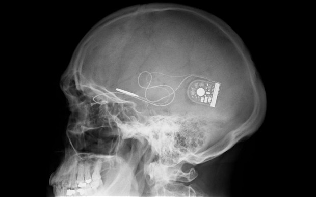 röntgenopname van schedel met electronisch hersenimplantaat